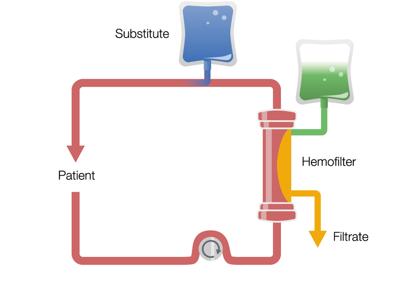 Continuous Veno-Venous Hemodiafiltration in postdilution (Post-CVVHDF)